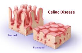 celiac disease for many the reason to change to a gluten free diet.